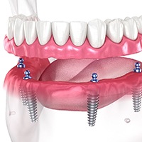 Implant dentures in Aurora
