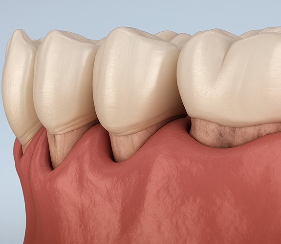 Digital image of gum pockets forming