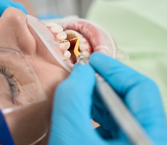Dentist charting depth of gum tissue