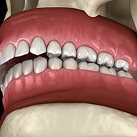 Digital image of an overbite